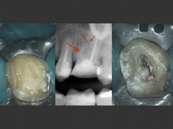 REMOVAL OF A BROKEN ROOT TOOL FROM THE TOOTH CANAL AND SUBSEQUENT PROSTHETIC TREATMENT